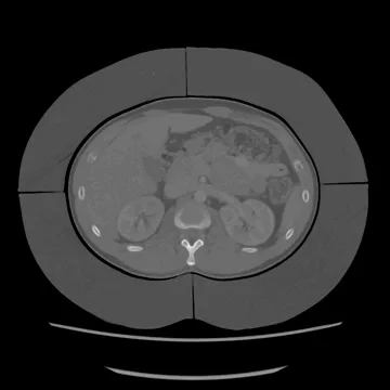 PhantomX  5 cm Fat Ring for Abdomen Phantom