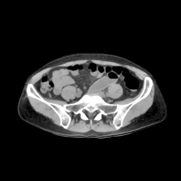 PhantomX Abdomen / Pelvis Phantom