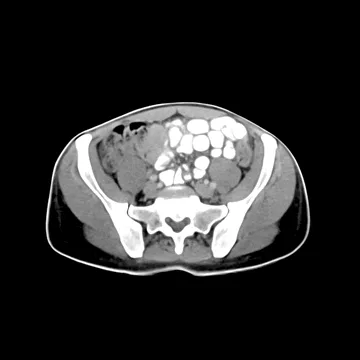 PhantomX Abdomen / Pelvis Phantom