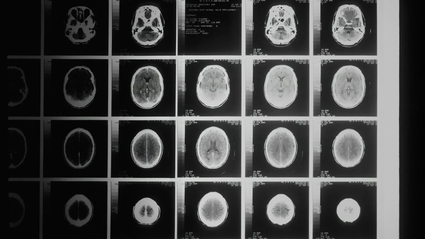 Functional Neurosurgery / Neuromodulation